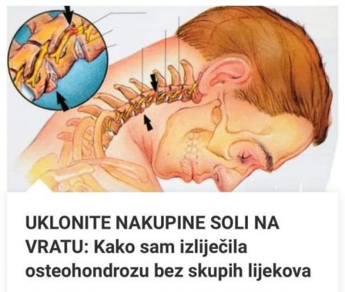 UKLONITE NAKUPINE SOLI NA VRATU Evo kako sam izliječila osteohondrozu