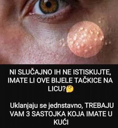 NI SLUČAJNO IH NE ISTISKUJTE IMATE LI OVE BIJELE TAČKICE NA LICU